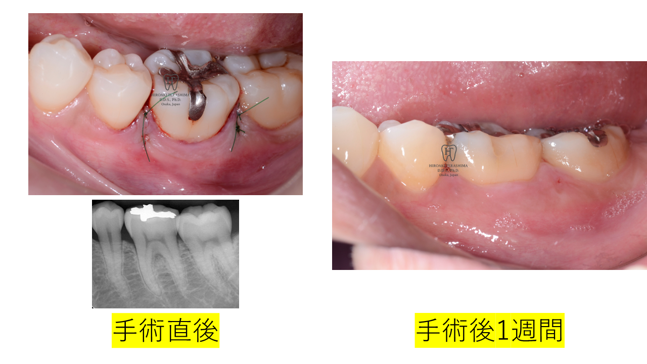 Ⅱ度分岐部病変に対する再生療法で長期安定を得た症例（左下6番・7年7