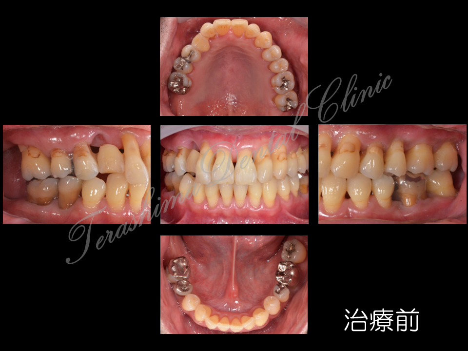 歯周病治療とインプラント治療の総合的治療の1症例 | 箕面市の歯医者