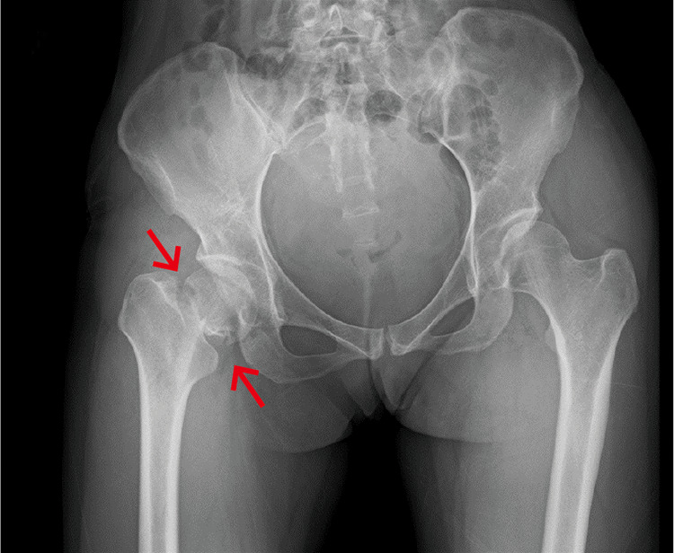 整形外科 お待たせしません！すぐつなぎます～大腿骨近位部骨折