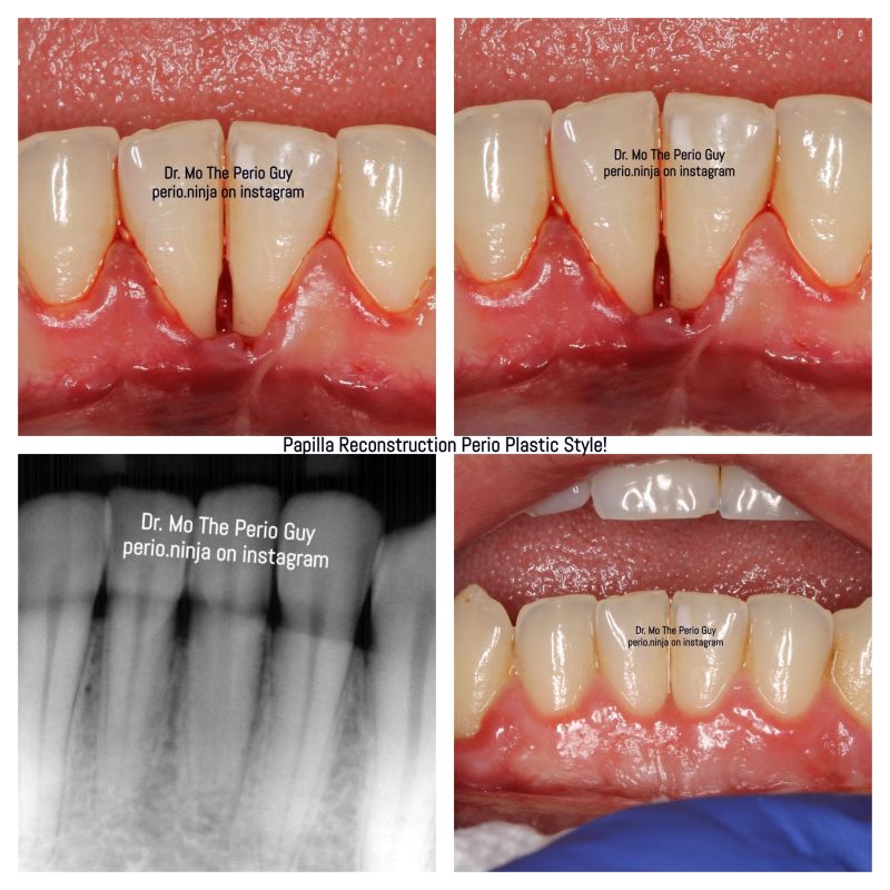 Papilla Reconstruction is Unpredictable at Best. There is no other