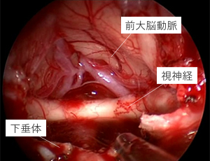 脳腫瘍下垂体腺腫の治療 | 医療法人重喜会 南福岡脳神経外科病院