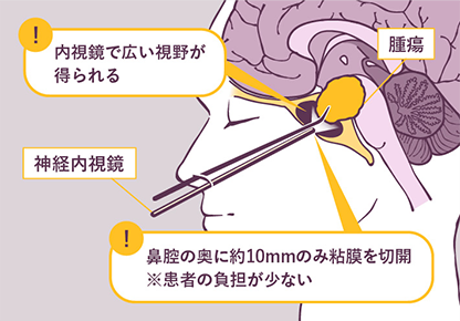脳腫瘍下垂体腺腫の治療 | 医療法人重喜会 南福岡脳神経外科病院