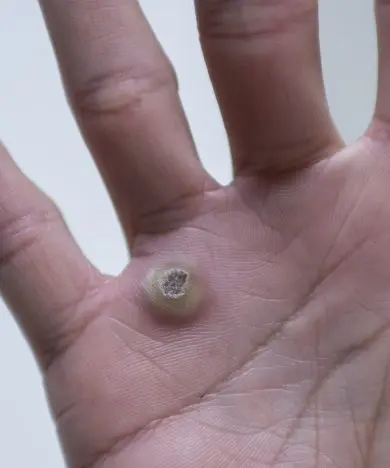 尋常性疣贅・ウイルス性いぼ治療｜JR武蔵新城駅徒歩1分（川崎市中原区