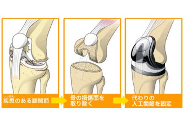 人工膝関節置換術後のリハビリテーション | みどり病院 | 神戸市、明石