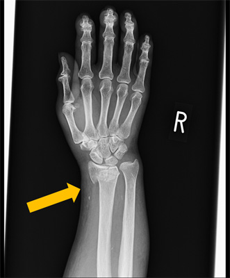 つまずいて手をついたとき起きやすい骨折は？〜高齢者の4大骨折の1つ