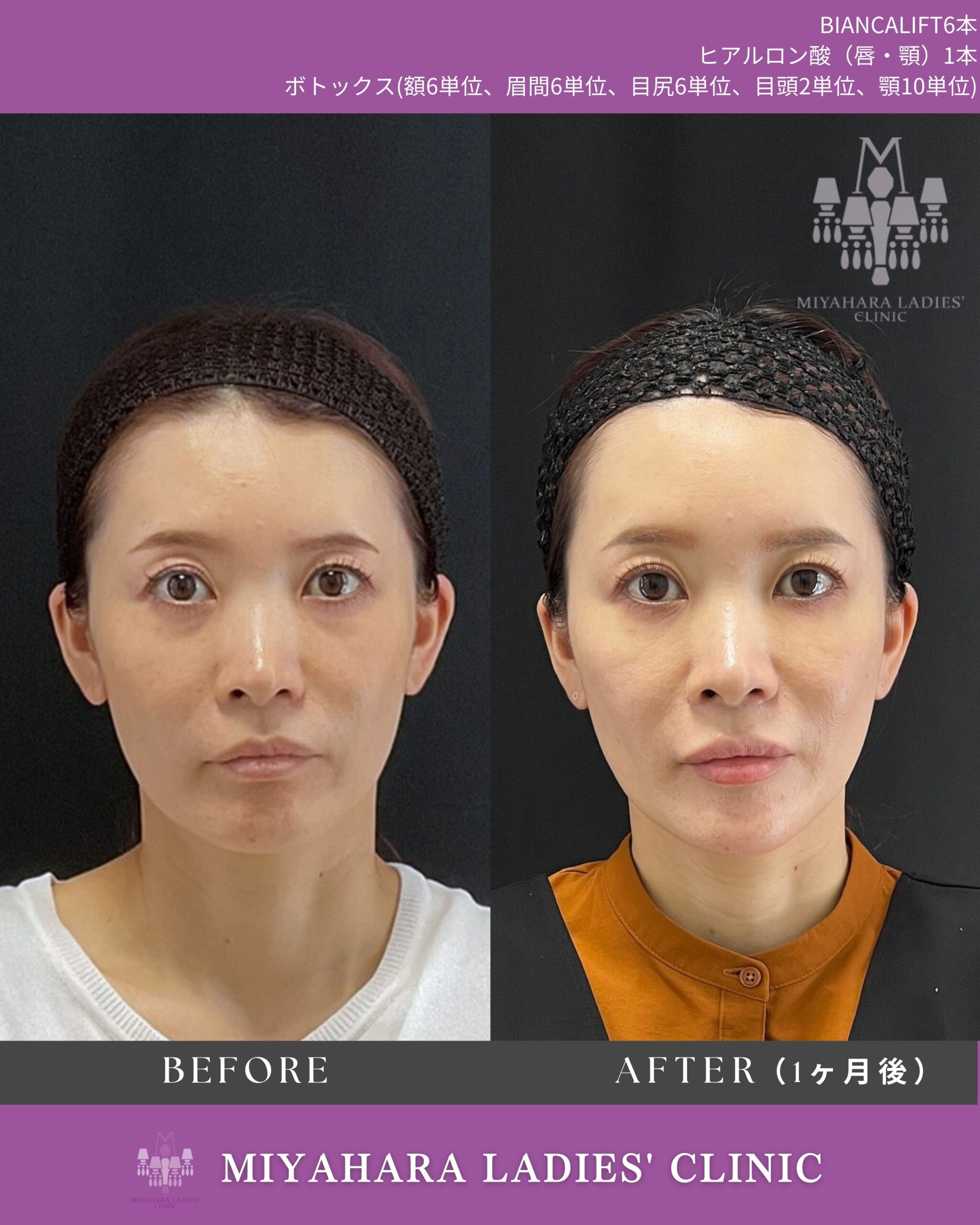 ボトックス注射 ｜ 熊本市 みやはらレディースクリニック 美容診療専用