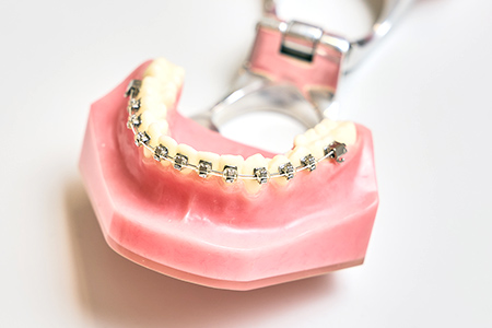 成人矯正｜鷺沼・あざみ野・横浜から通える矯正専門の歯医者 みやまえ