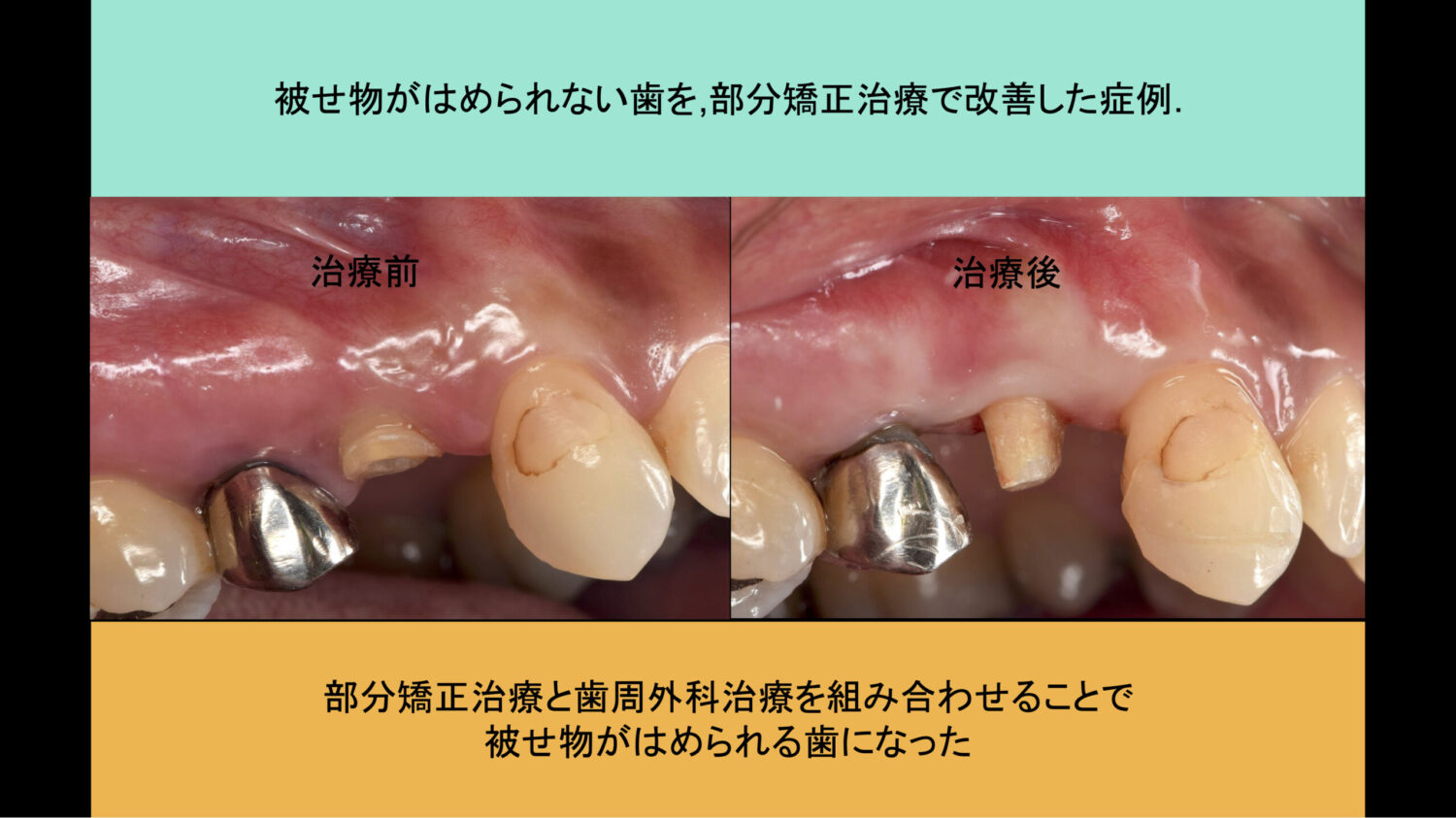 部分矯正治療症例（MTM） & 歯周外科治療症例 | 大津市の歯医者なら