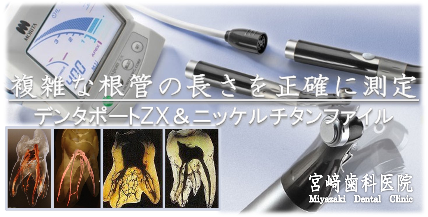 根管治療 ニッケルチタンファイル