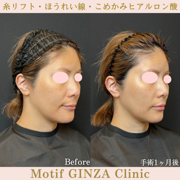 糸リフト（スレッドリフト） | 美容外科、婦人科形成の東京の