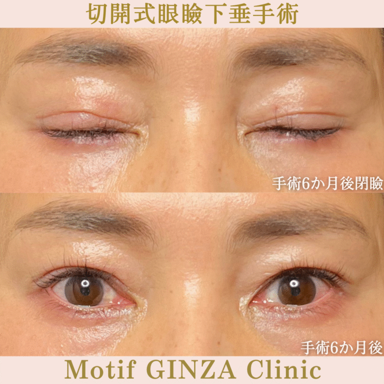 眼瞼下垂手術 | 美容外科、婦人科形成の東京のモティーフ銀座クリニック