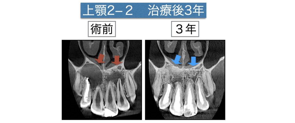 根の先の病気（根尖病変）が大きいので抜歯です。」は本当？ | 歯内