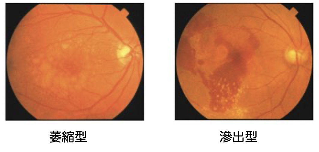 加齢性黄斑変性 | 診療のご案内 | もりや眼科 奈良市の白内障手術
