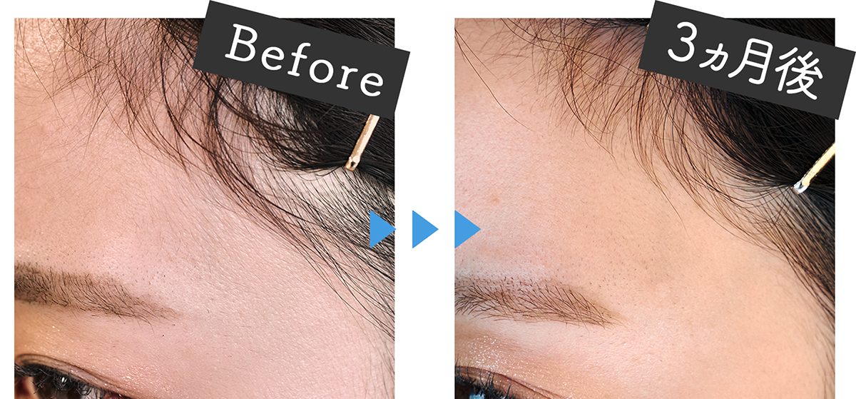 ミュゼの家庭用光美容器ってほんとにムダ毛ケア効果あるの？3ヶ月体験