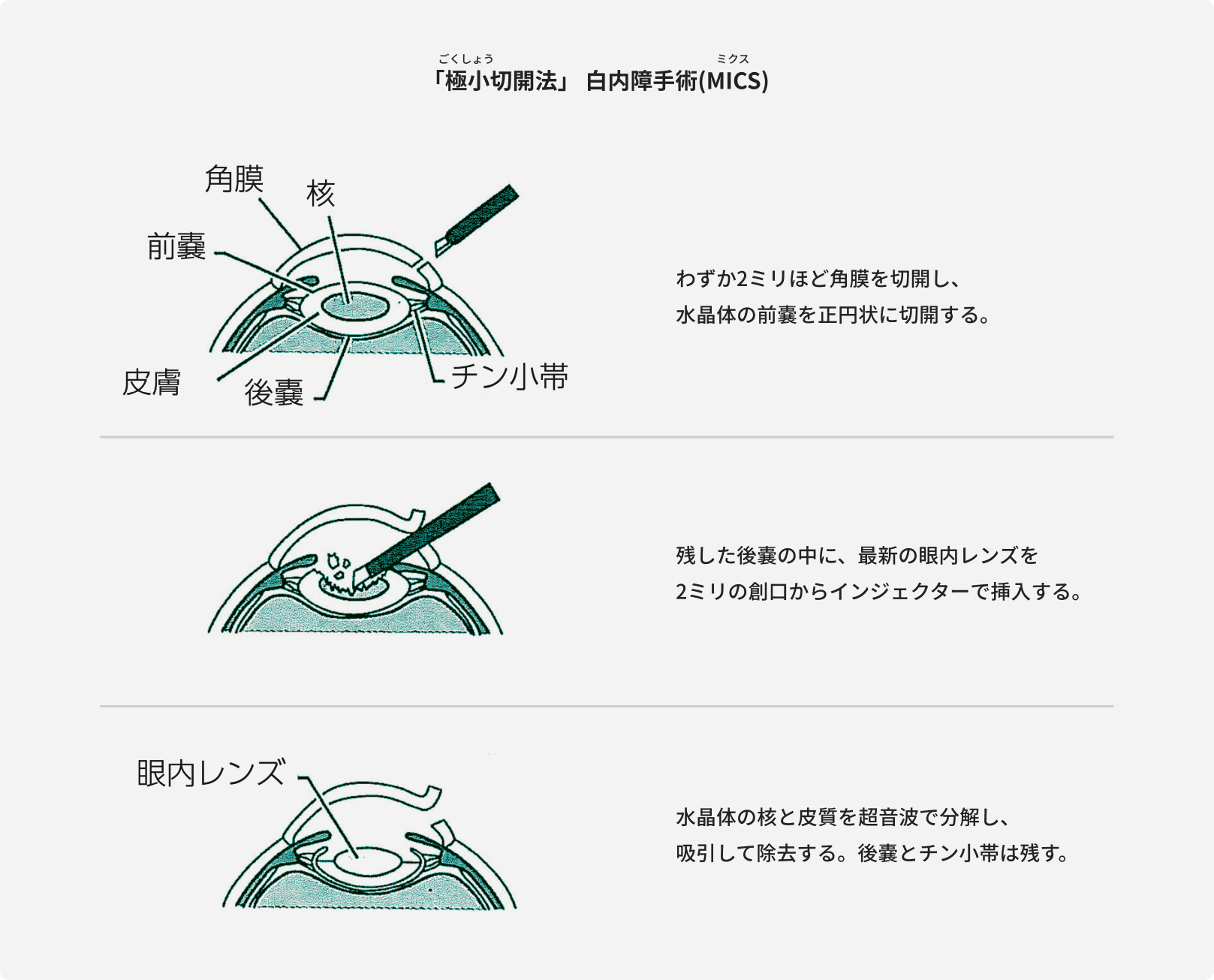 05.最良の白内障手術の実施のための当院の取り組み | 白内障 | 熊本