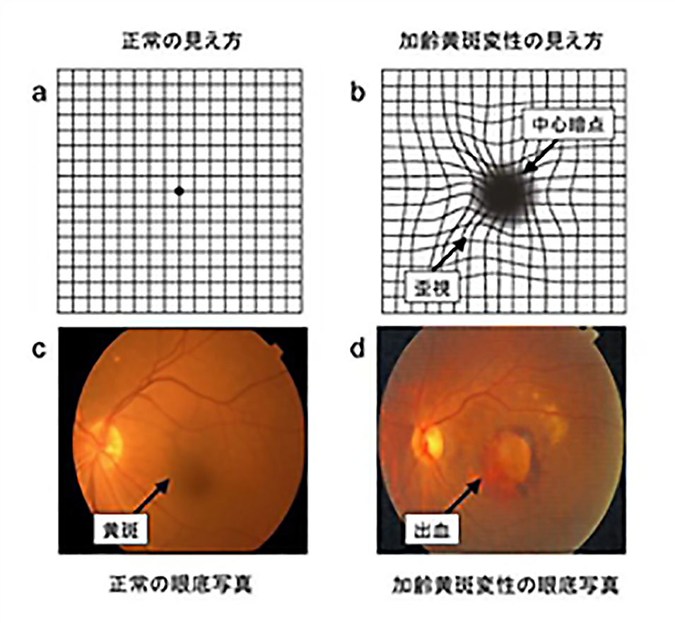 加齢黄斑変性症 | 診療内容 | 医療法人 慶心会 なかやま眼科クリニック