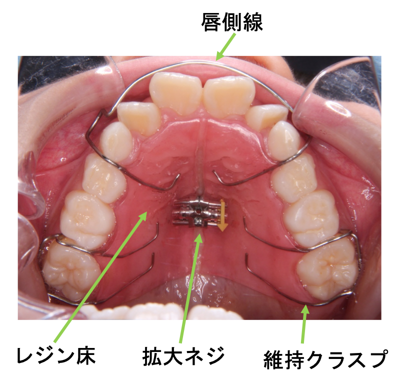 拡大床（拡大プレート/緩徐拡大装置）｜奈良の矯正歯科なら【おとなと