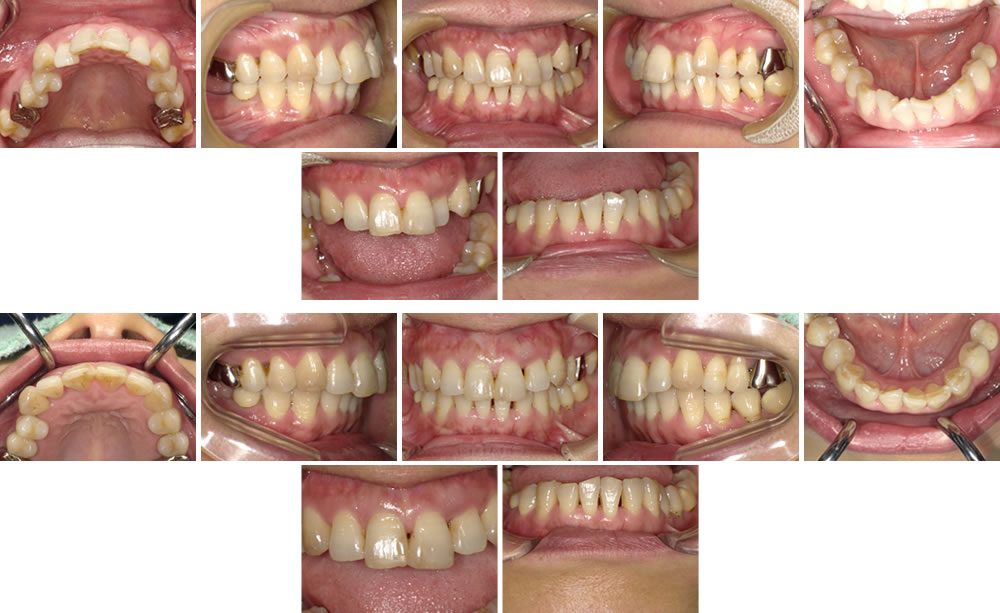 アライナーによる部分矯正治療例（40代女性 治療期間1年3ヵ月） | 愛知