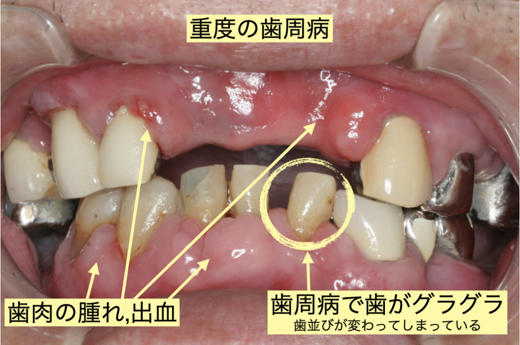 ボロボロの歯はどう治療する？7つの方法と気になる治療費・期間も紹介