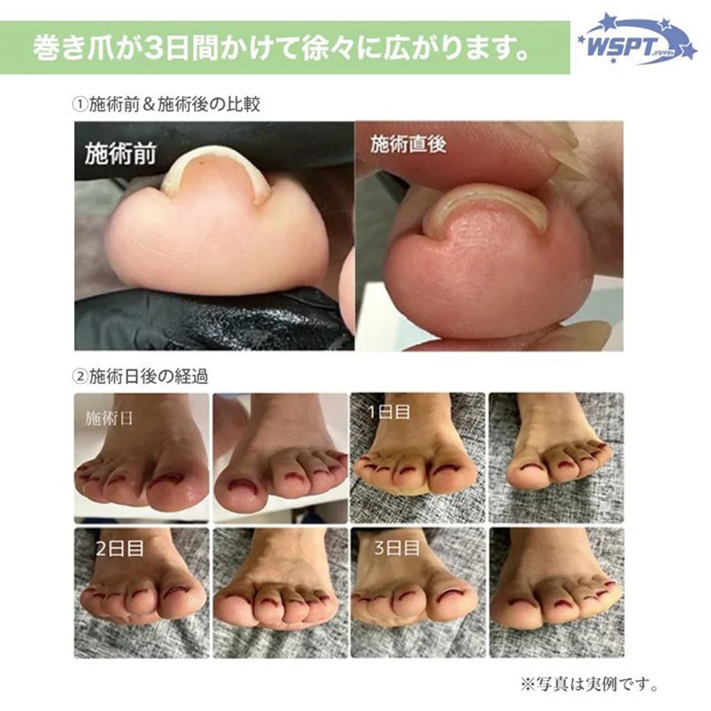 WSPT JAPAN 巻き爪ケア フラットケアジェル 7ml 3本セット / NES