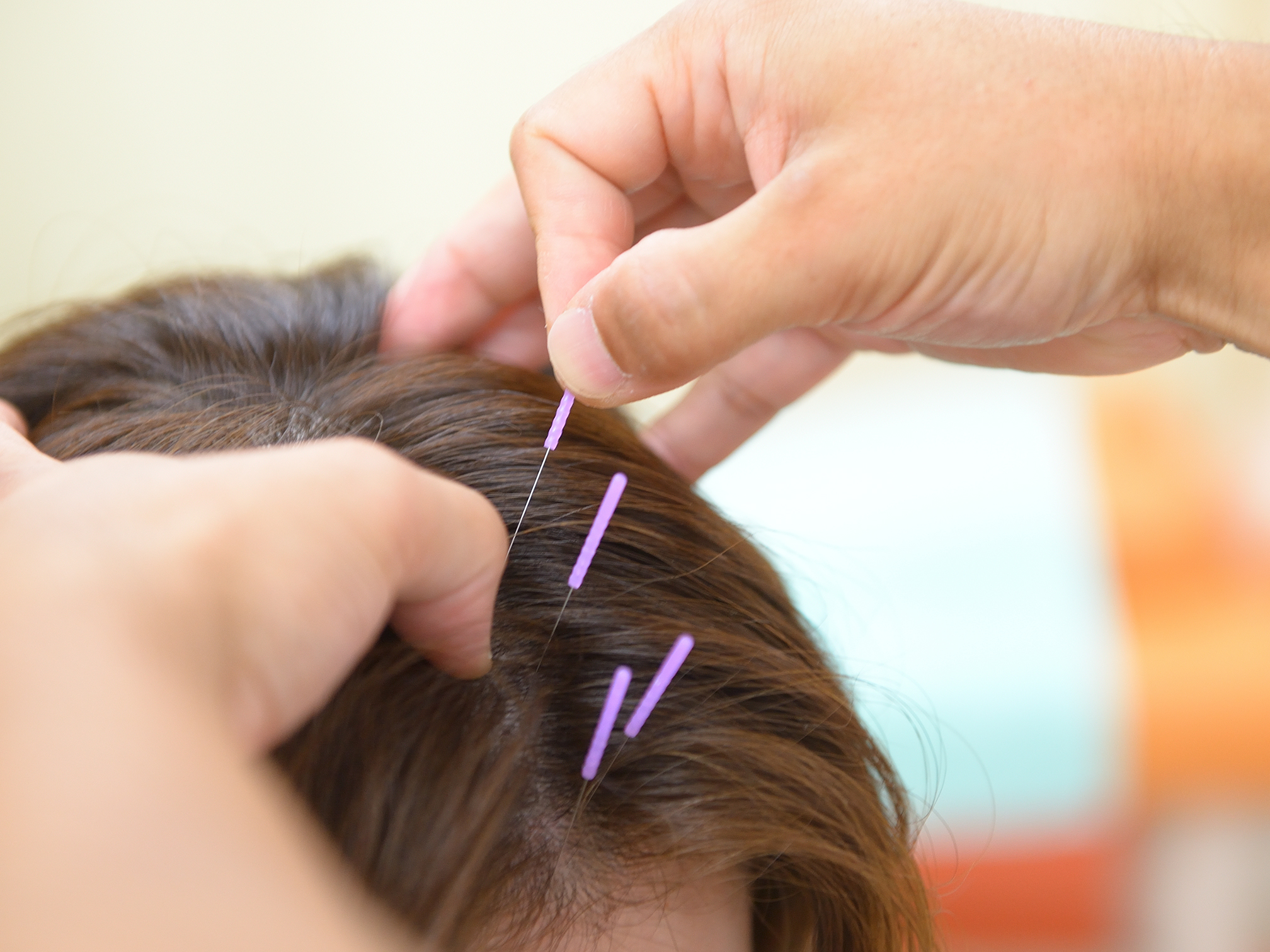 YNSA（山元式新頭鍼療法）とは？成田で受けられる最先端の鍼灸治療