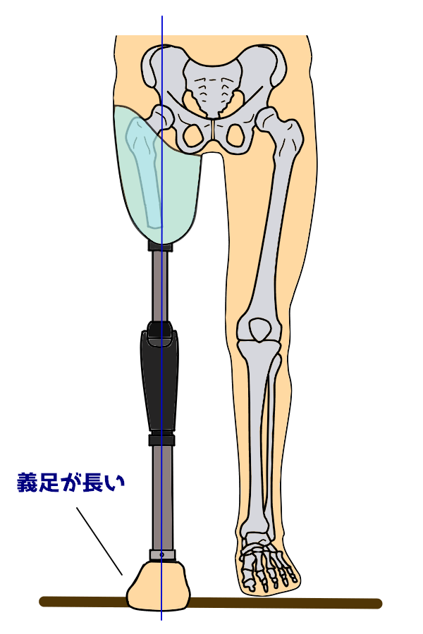 PTOT国家試験解説 大腿義足の異常歩行 | なぜなに。装具 まとめ