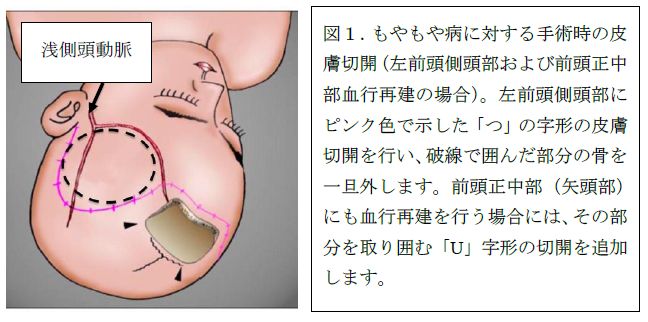 脳血管障害 - もやもや病