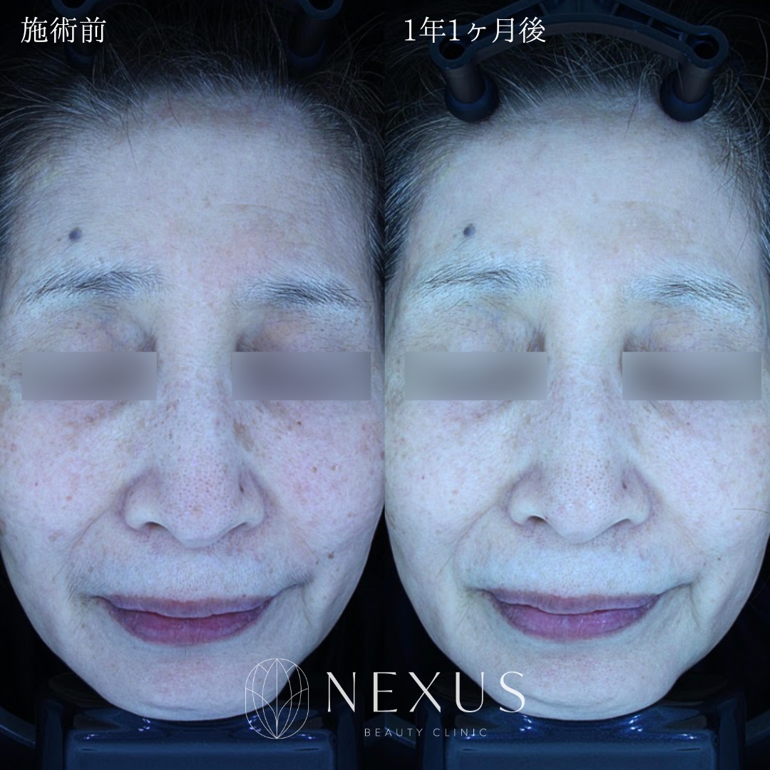 エレクトロポレーション | 美容整形は東京 銀座 有楽町の美容外科