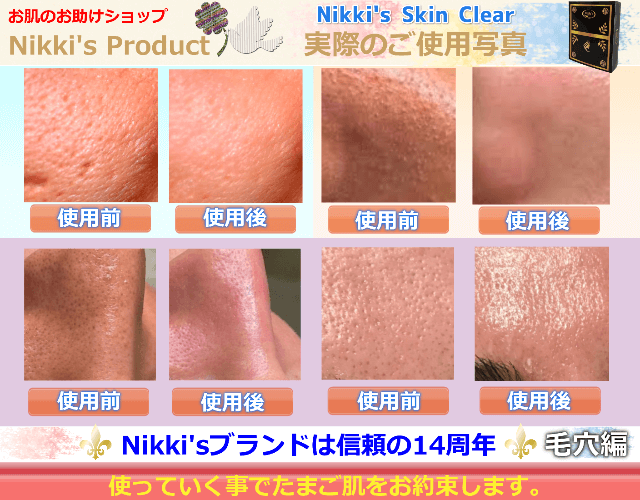 ニッキーズスキンクリア Nikki's Skin Clear 通常使用 (シミ、そばかす