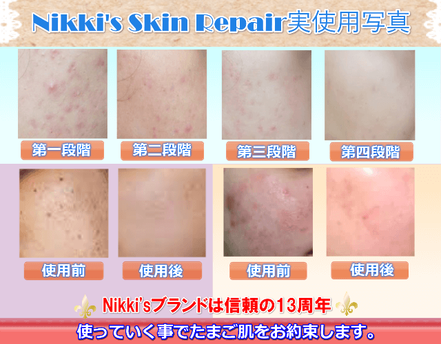 ニッキーズスキンリペア Nikki's Skin Repair(シミ、そばかす除去