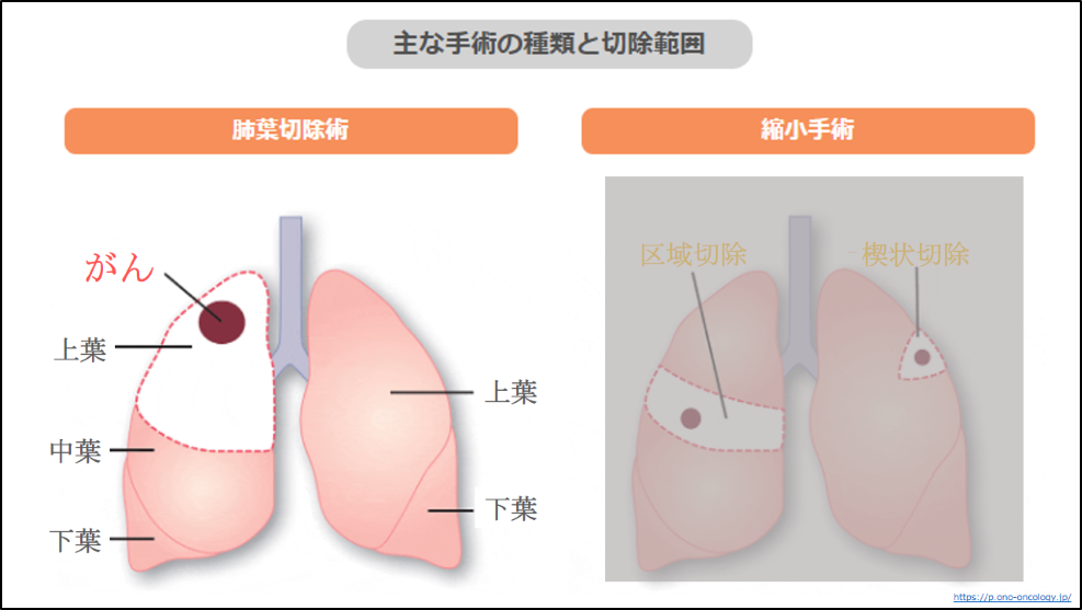 肺がんの手術治療 | 新座志木中央総合病院