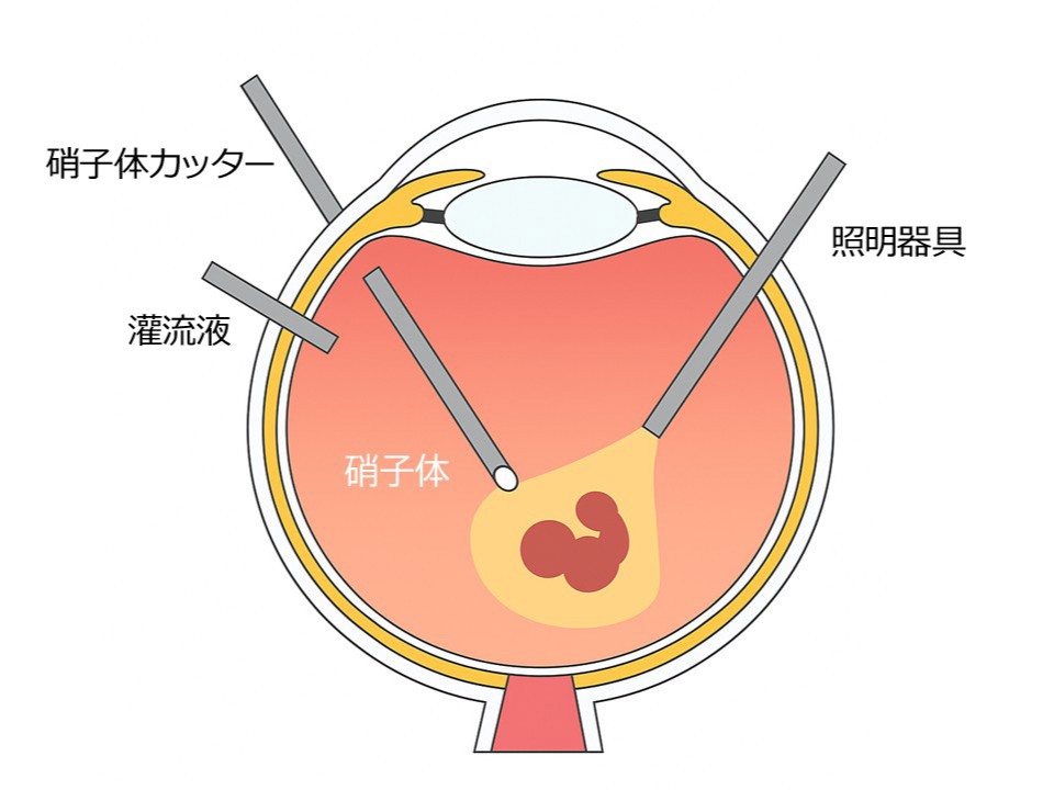網膜・硝子体手術｜大阪府済生会野江病院