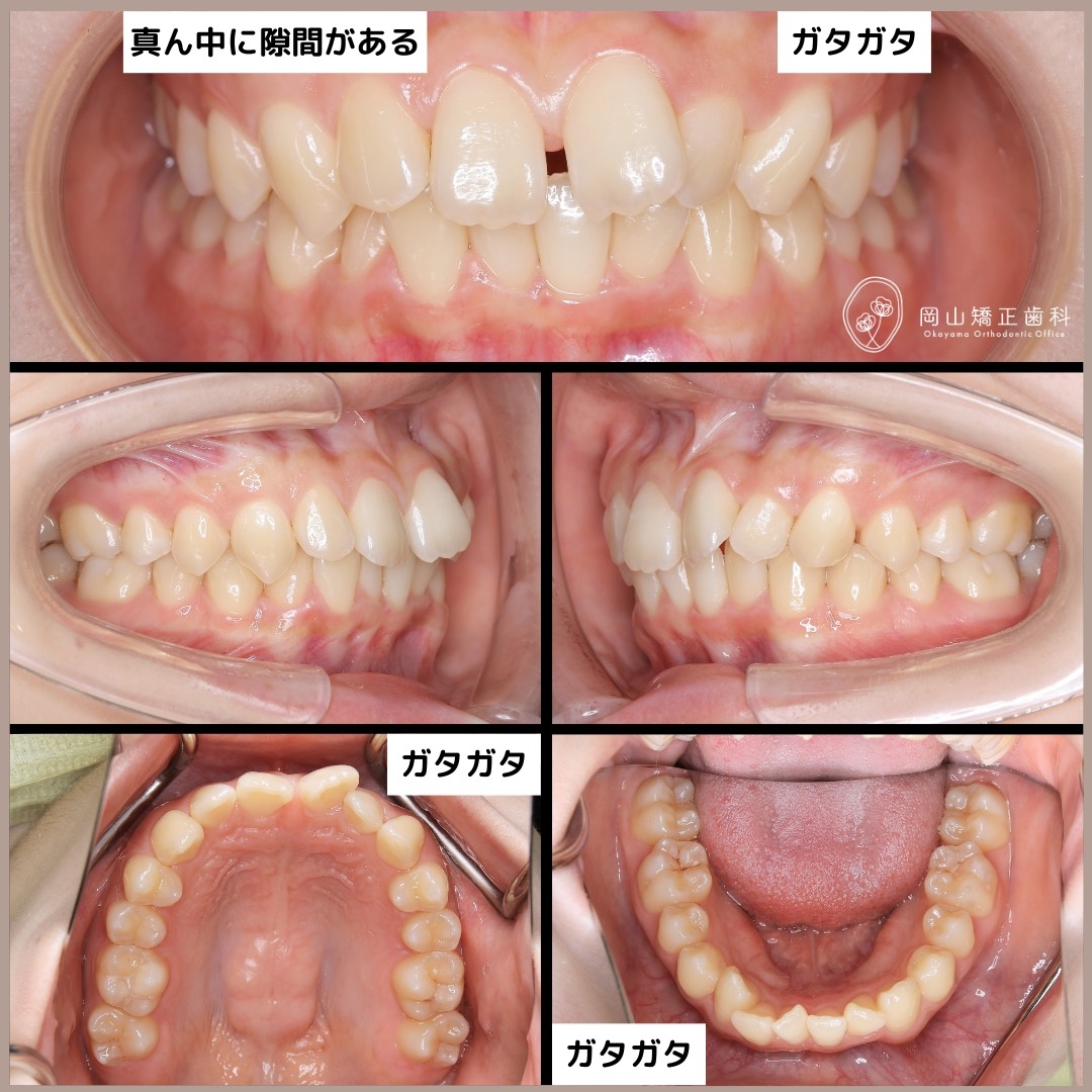 メル20723】アライナー矯正歯科治療 アライナー矯正歯科治療 | Sandra