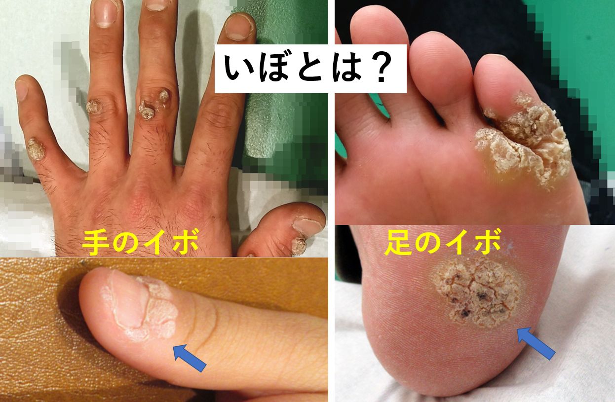 いぼ｜大田区大森・大木皮膚科【尋常性疣贅・イボ治療専門外来】