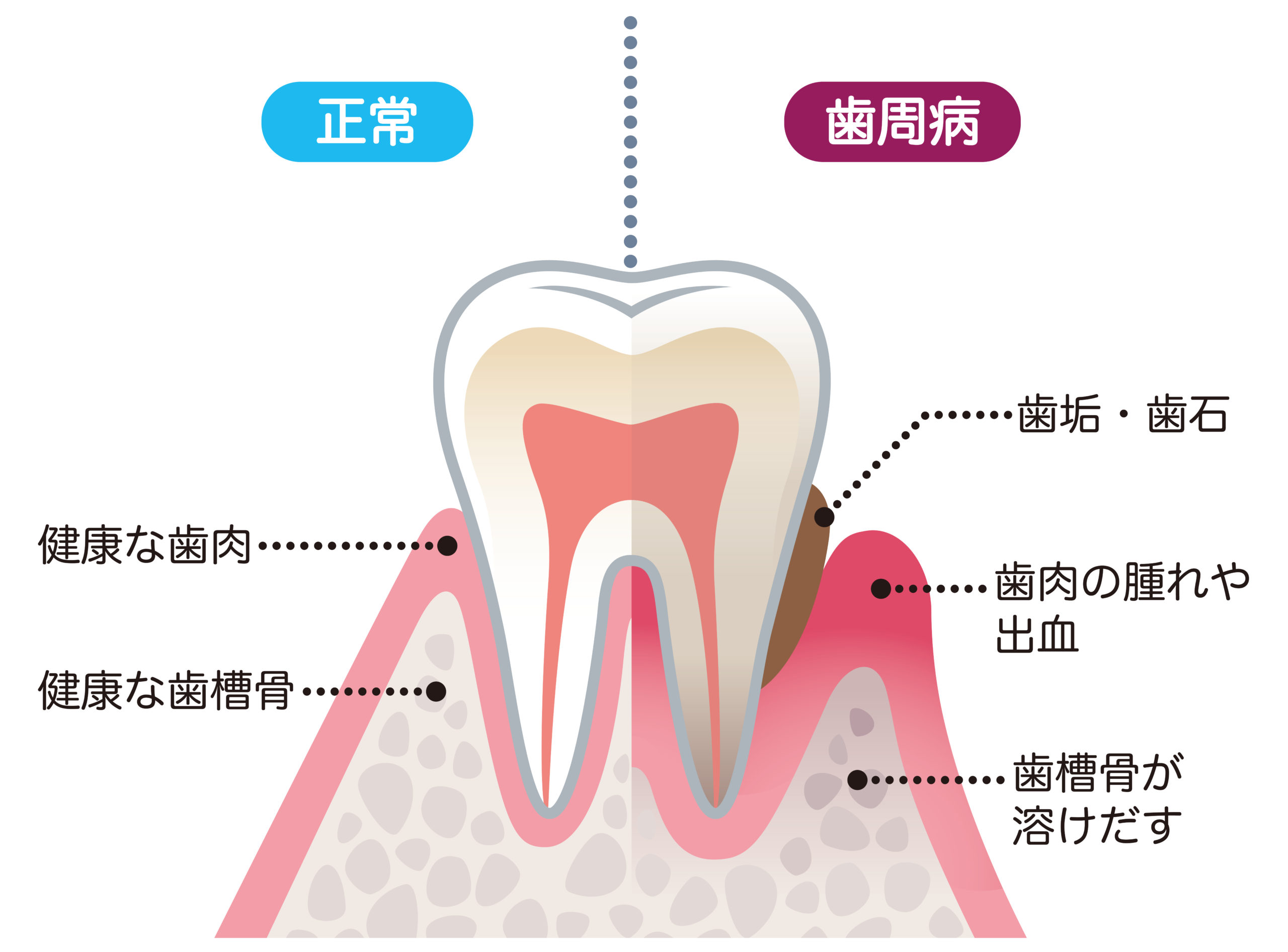 歯周病の原因と大切な予防歯科 | デンタルコラム | おくだ歯科医院