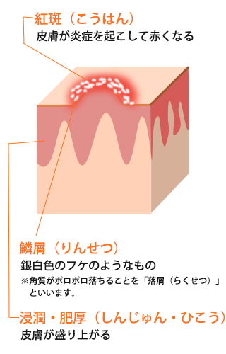 乾癬・掌蹠膿疱症（しょうせきのうほうしょう） | おおしま皮膚科