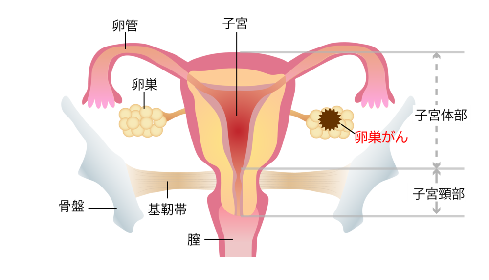 卵巣がん - 大阪けいさつ病院｜大阪国際メディカル＆サイエンスセンター