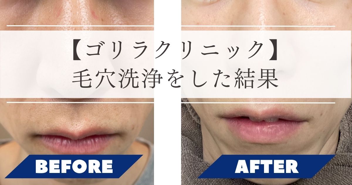 写真あり体験談】ゴリラクリニックのハイドラフェイシャルを施術した