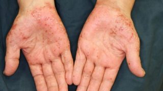 掌蹠膿疱症 | 大山皮ふ科 形成外科