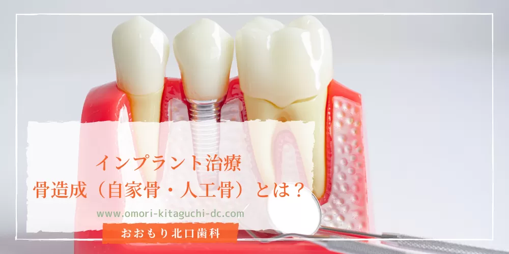 インプラント治療 骨造成（自家骨・人工骨）とは？ | おおもり北口歯科