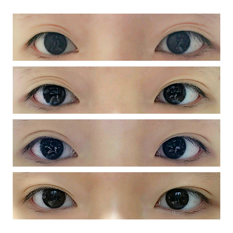 Eyelids Fold アイリッドフォールド 美容 Optifold EyelidShaping
