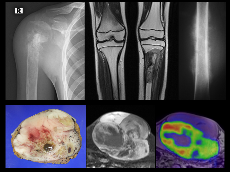 骨・軟部肉腫（悪性骨腫瘍、悪性軟部腫瘍） - 福島県立医科大学 整形外