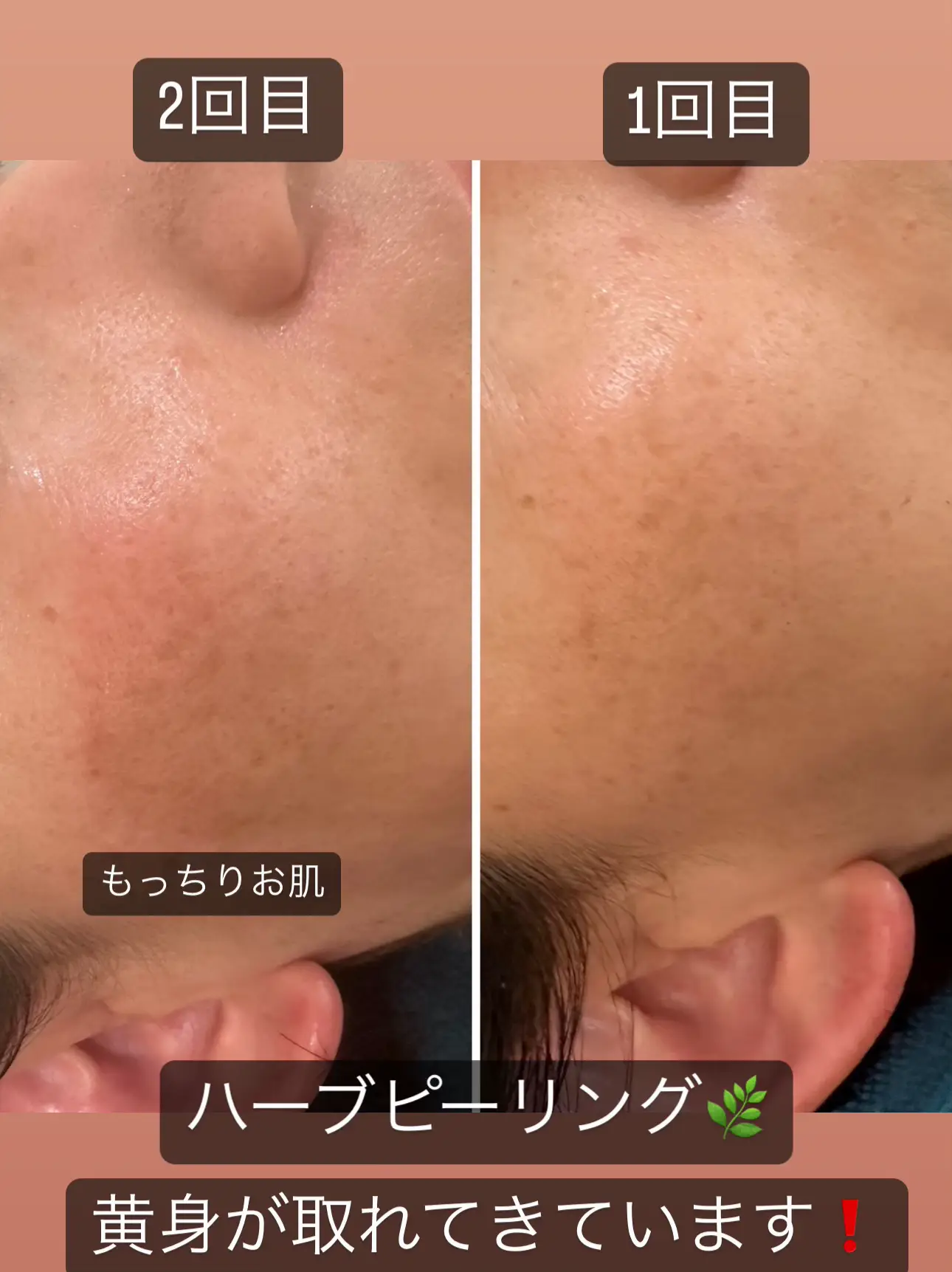 ハーブピーリング 剥離あり 20回分 ローション付き 【公式通販】