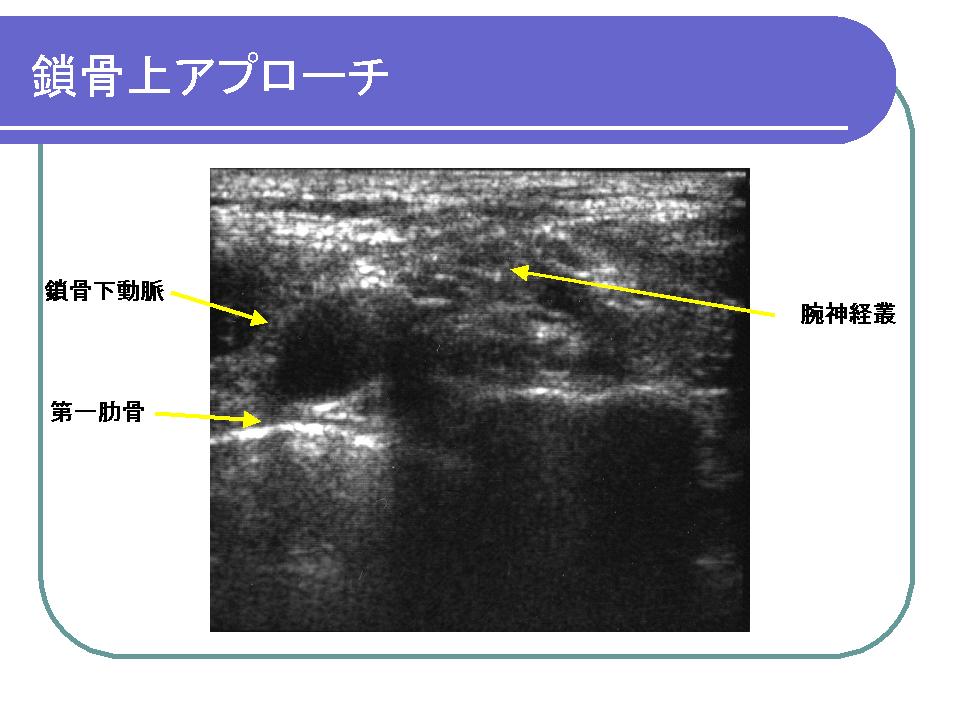 超音波ガイド下末梢神経ブロック入門(3) : 電脳麻酔ブログ