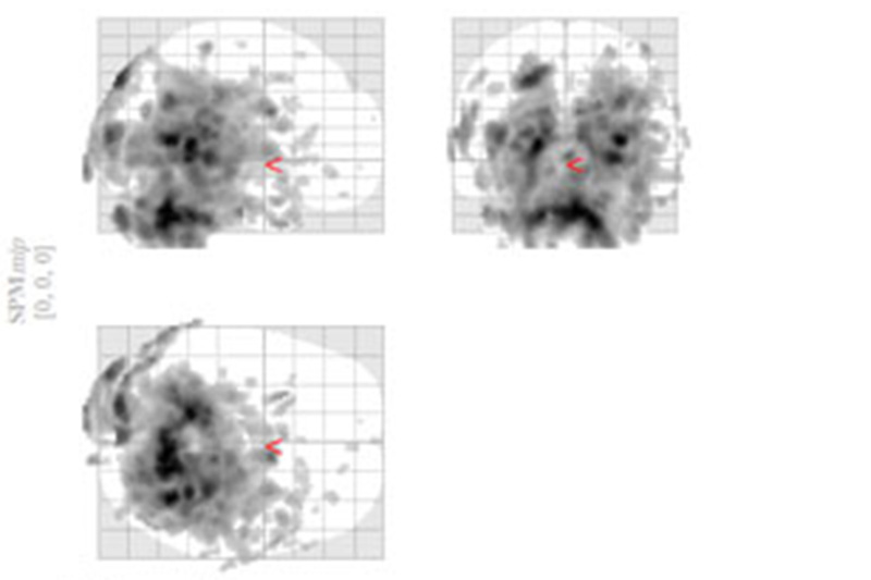 脳脊髄液調整法(CSFプラクティス) ソフトブロックテクニックの