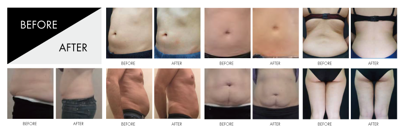 THE COOL FOUR-脂肪冷却痩身- | 沖縄県うるま市/private salon Pika