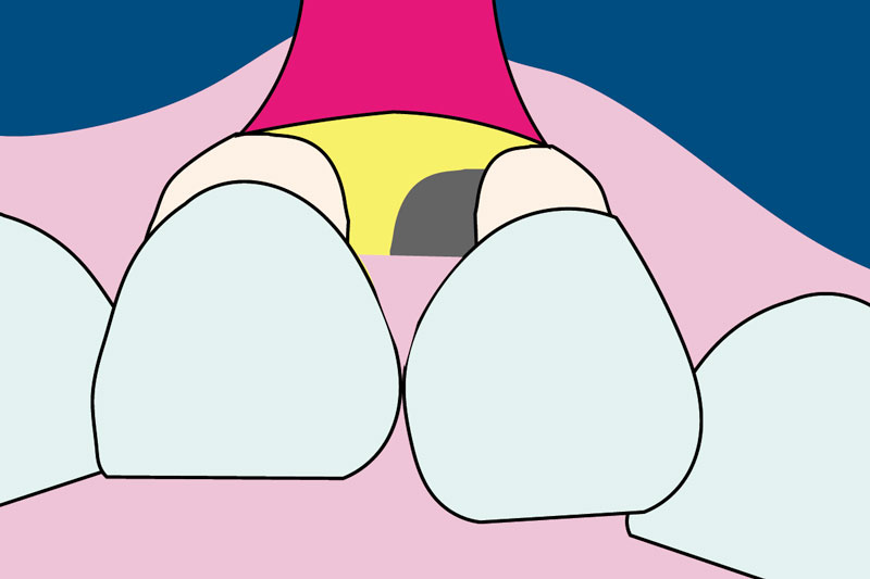Modified Minimally Invasive Surgical Technique（M-MIST） | WHITE CROSS