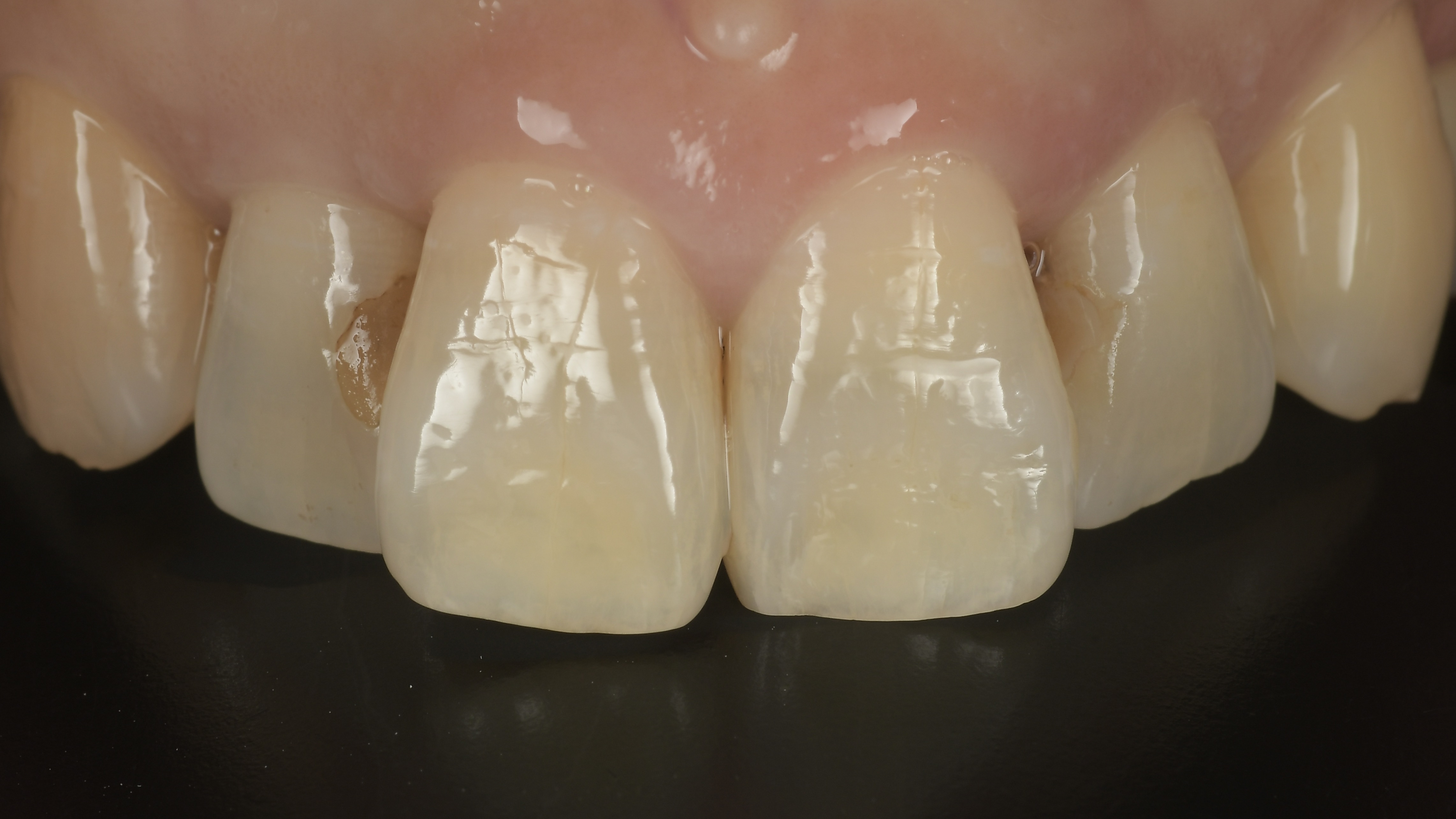 Case report】短時間で審美的コンプレックスを解消した前歯部レジン