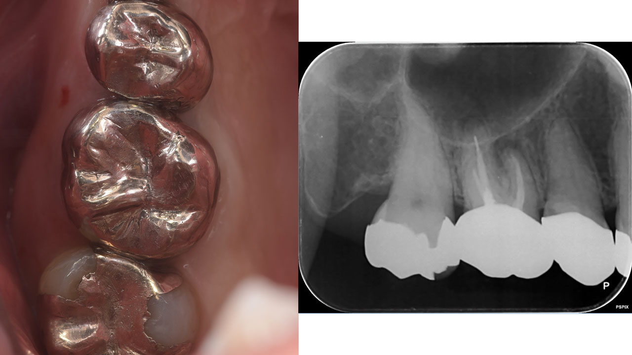 侵襲度が高いサイナスリフトに革命？！ワイドショートで変わる上顎臼歯