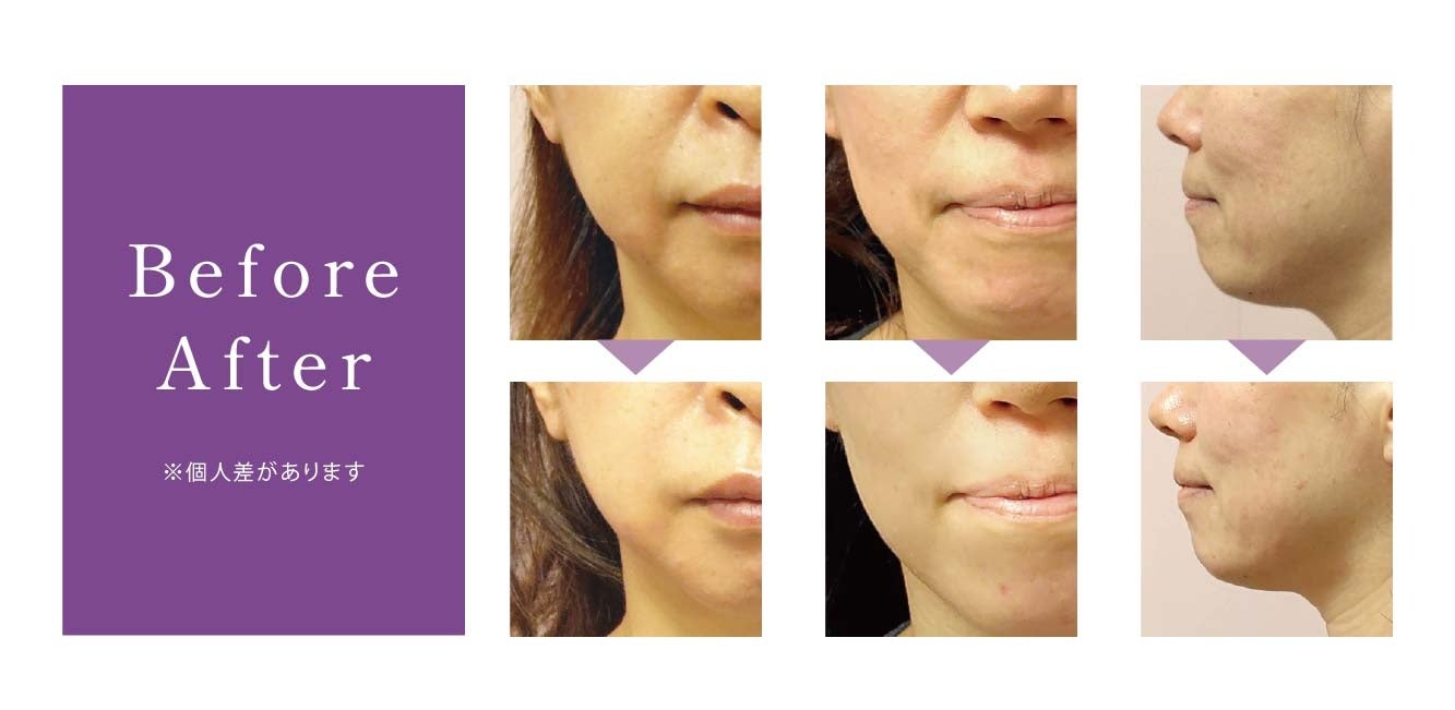 サロンで施術可能！新世代の「 コラーゲン 糸リフト 」を販売開始